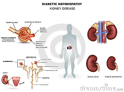 Diabetic Nephropathy, kidney disease Vector Illustration