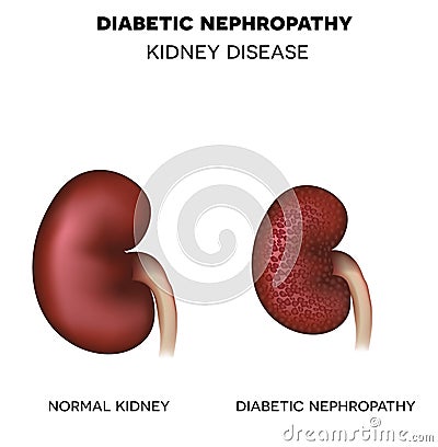 Diabetic Nephropathy, kidney disease Vector Illustration