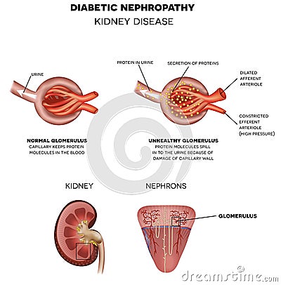 Diabetic Nephropathy, kidney disease Vector Illustration