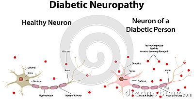 Diabetic Neuropathy Vector Illustration