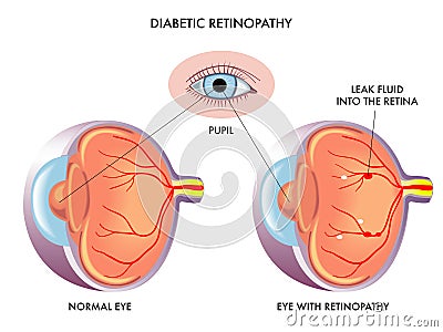 Diabetic retinopathy Vector Illustration