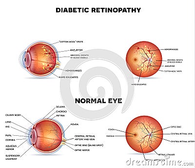 Diabetic retinopathy Vector Illustration