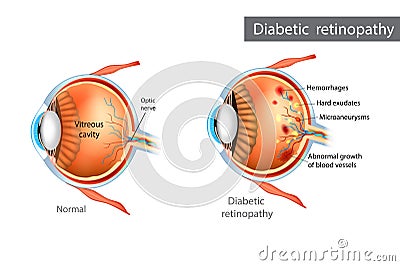 Diabetic retinopathy. Difference between Normal Retina and Diabetic Retinopathy Vector Illustration