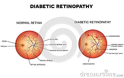 Diabetic retinopathy Vector Illustration