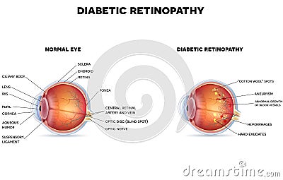 Diabetic retinopathy Vector Illustration