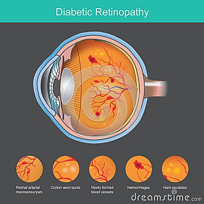 Diabetic Retinopathy. Illustration abnormality the retina from symptoms the diabetic Vector Illustration