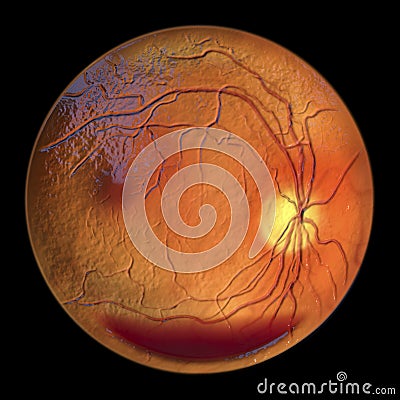 Diabetic retinopathy, ophthalmoscopic diagnosis, illustration Cartoon Illustration