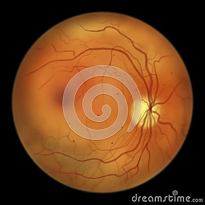 Diabetic retinopathy, ophthalmoscopic diagnosis, illustration Cartoon Illustration