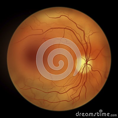 Diabetic retinopathy, ophthalmoscopic diagnosis, illustration Cartoon Illustration