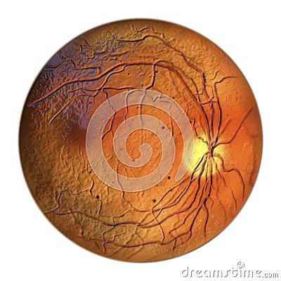 Diabetic retinopathy, ophthalmoscopic diagnosis, illustration Cartoon Illustration