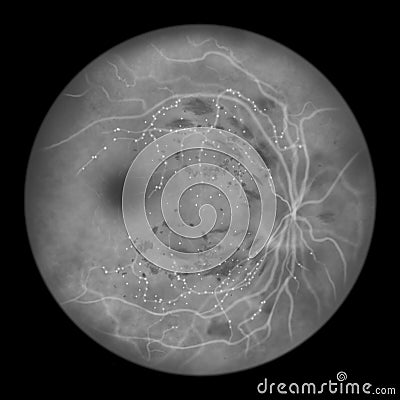 Diabetic retinopathy, ophthalmoscopic diagnosis, illustration Cartoon Illustration