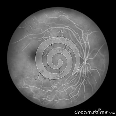 Diabetic retinopathy, ophthalmoscopic diagnosis, illustration Cartoon Illustration