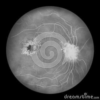 Diabetic retinopathy, ophthalmoscopic diagnosis, illustration Cartoon Illustration