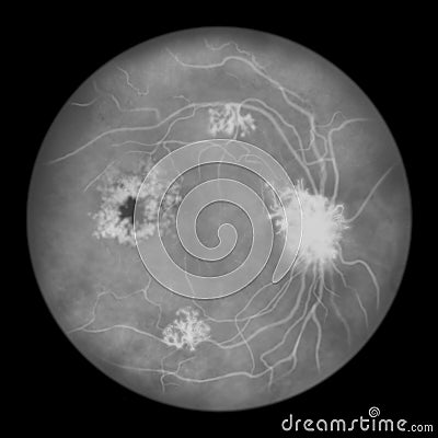 Diabetic retinopathy, ophthalmoscopic diagnosis, illustration Cartoon Illustration