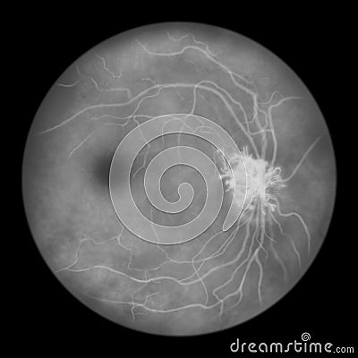 Diabetic retinopathy, ophthalmoscopic diagnosis, illustration Cartoon Illustration