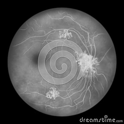 Diabetic retinopathy, ophthalmoscopic diagnosis, illustration Cartoon Illustration