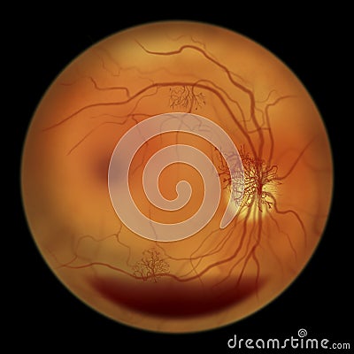 Diabetic retinopathy, ophthalmoscopic diagnosis, illustration Cartoon Illustration