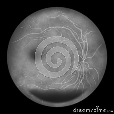 Diabetic retinopathy, ophthalmoscopic diagnosis, illustration Cartoon Illustration