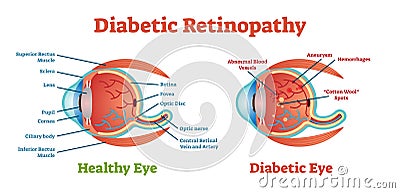 Diabetic Retinopathy vector illustration diagram, anatomical scheme. Vector Illustration