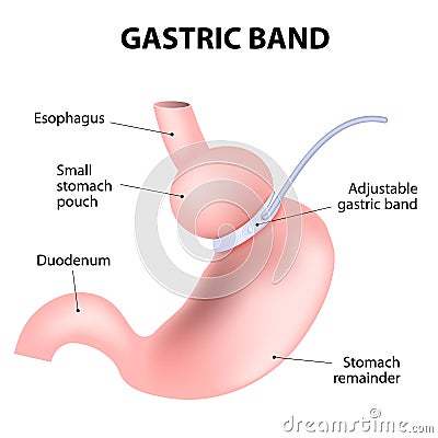 Diagram of an adjustable gastric band Vector Illustration