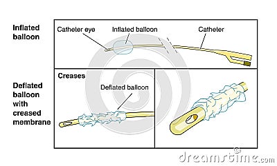 Diagram of a catheter Stock Photo