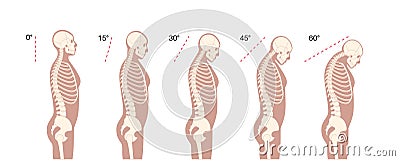 Neck vertebrae deformity Vector Illustration