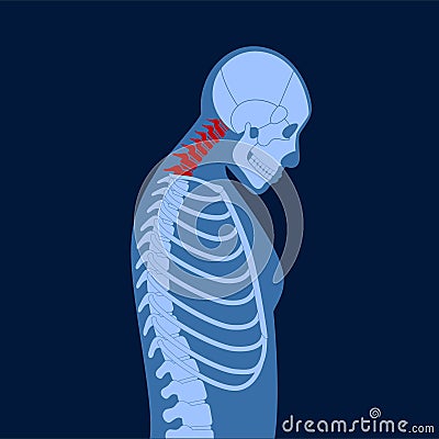 Neck vertebrae deformity Vector Illustration