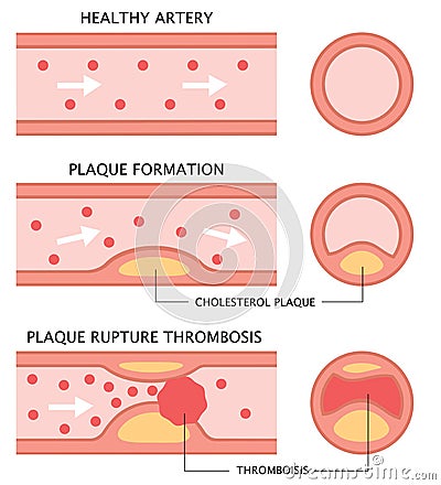 Atherosclerosis stages: healthy artery, plaque formation, and thrombosis in flat style isolated on white background. health care c Vector Illustration