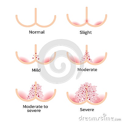 Diaper rash types Vector Illustration