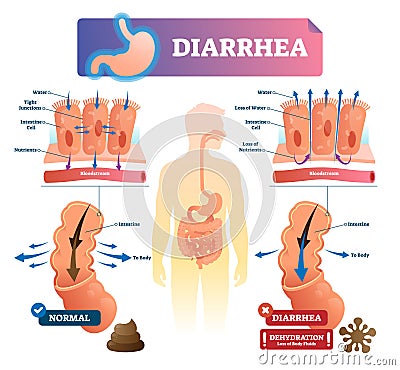 Diarrhea vector illustration. Labeled stomach gut illness medical scheme. Vector Illustration