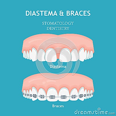 Diastema and Braces. Stomatology dentistry vector concept Vector Illustration