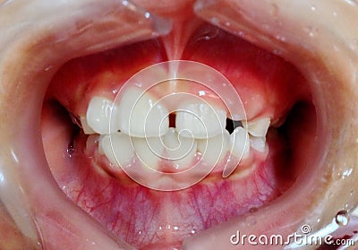 The diastema teeth on child Stock Photo