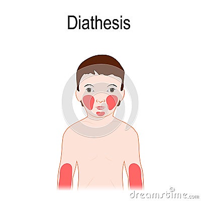 Diathesis. Atopic dermatitis atopic eczema. Location on a huma Vector Illustration