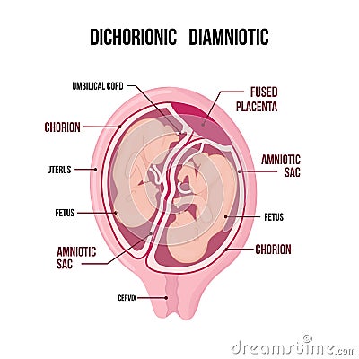 Dichorionic diamniotic twins with fused placenta Vector Illustration