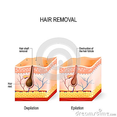 The difference between epilation and depilation. Vector Illustration