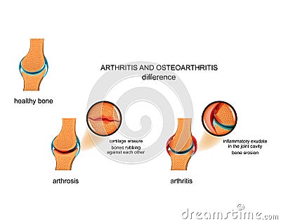 Differences arthrosis from arthritis Vector Illustration