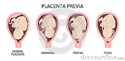 Different Placental Locations During Pregnancy. Major and Normal placenta previa, total and partial. Vector Illustration