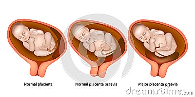 Different Placental Locations During Pregnancy Vector Illustration