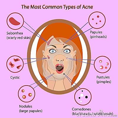 Different type of acne. Vector Illustration with skin problems. woman face isolated Vector Illustration