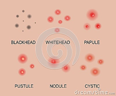 Different types of acne. Acne skin types. Blackheads, whiteheads, papules, pustules, cystic and nodular. Skincare Vector Illustration