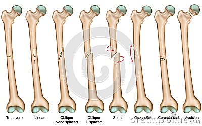 Bone fracture types medical vector illustration Vector Illustration