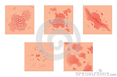 Different types of psoriasis vector set. Part of patients skin with dermatitis, inflammation, red rash and other skin Vector Illustration