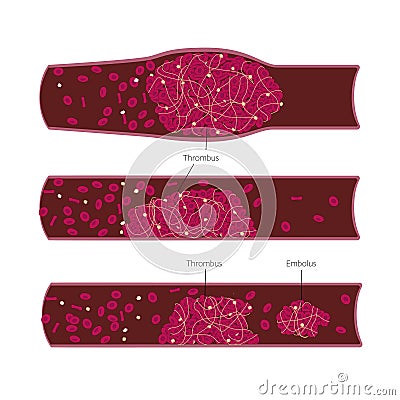Different types of thrombus and embolus in the blood vessels closup illustration. Medical chart for science or education Vector Illustration