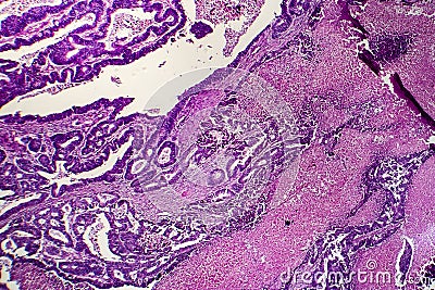 Differentiated intestinal adenocarcinoma, light micrograph Stock Photo