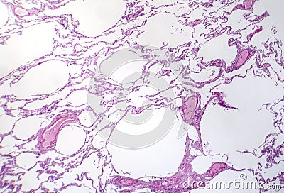 Diffuse emphysema, light micrograph Stock Photo