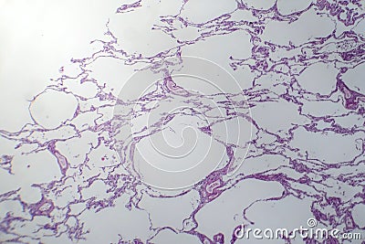 Diffuse emphysema, light micrograph Stock Photo