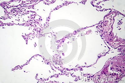 Diffuse emphysema, light micrograph Stock Photo