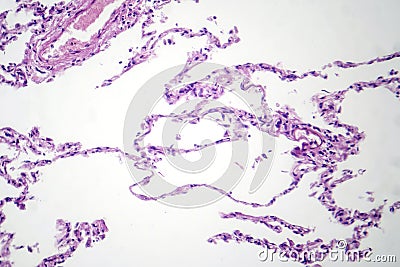 Diffuse emphysema, light micrograph Stock Photo