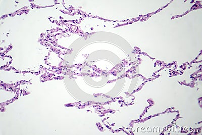 Diffuse emphysema, light micrograph Stock Photo