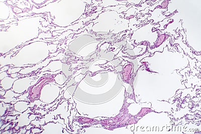 Diffuse emphysema, light micrograph Stock Photo